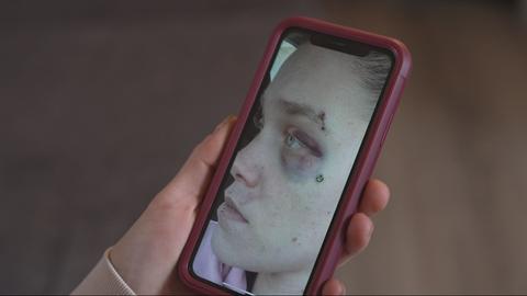 Auf einem Handy sieht man das Foto einer Frau Ende 20 mit einem Blauen Auge